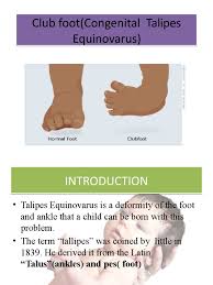 Перевод песни club foot — рейтинг: Club Foot Foot Congenital Disorder