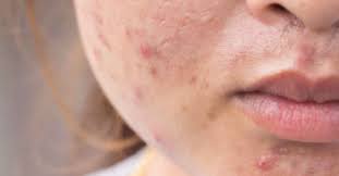 Dan tak semua kaedah sesuai untuk semua orang. Cara Penjagaan Kulit Muka Berminyak Dan Berjerawat Secrets Living