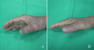 The patient is placed in a dynamic extension splint with the wrist in 30 to 45 degrees of extension and the basal joint placed in full extension and abduction. Extensor Pollicis Longus Or Brevis Tendon Rupture After Corticosteroid Injection Sciencedirect
