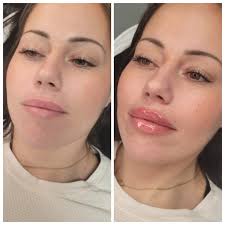 Hi all! My name is Amy Gensale, NP-C, and I own Goddess Aesthetics Medspa  in Dracut, Ma. I offer botox, dermal fillers, Diamond Glow facials, weight  loss injections, microneedling, chemical peels, Kybella,