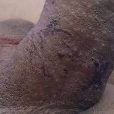 If you can afford it, there is no better way than this. I Got These Burns After A Laser Hair Removal Treatment Are They Permanent Photo
