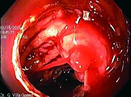 Hemorragia digestiva baja masiva por lesión de Dieulafoy de colon. Reporte  de caso con video