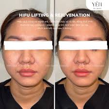 HIỆU QUẢ HIFU LIFTING & REJUVENATION TẠI YÊN SPA + BEAUTE Sau 1 tháng trải  nghiệm công nghệ HIFU, gương mặt đã có sự thay đổi rõ rệt: 👉 Rãnh cười mờ