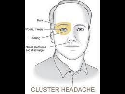 Image result for Cluster Headache