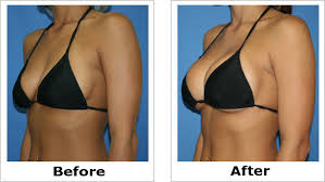 Résultat de recherche d'images pour "breast implant before and after"