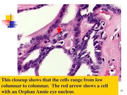 Warner upon noticing tumor cells with empty nuclei or those showing just a thin rim of peripheral chromatin in sections of papillary thyroid carcinoma. Diseases Of The Endocrine System Diseases Of The Thyroid Gland Ppt Download