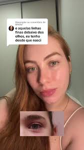 Olheiras e Dermatite Atópica: Causas e Tratamento