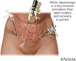 Hysterectomy is a type of surgery in which a woman's uterus (or womb) is removed, sometimes along with the ovaries, cervix, fallopian tubes, or other in many cases, hysterectomy—particularly if it's elective—isn't covered by insurance. Hysterectomy Information Mount Sinai New York