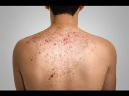 أسباب وعلاج حبوب الكتف المرسال