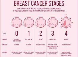 We see a very large volume of cases, more than 14,000 a year. Oncolytics Biotech V Twitter Breast Cancer How Fast Does It Spread Mnt Has Great Overview Including Symptoms Diagnosis Treatment And Outlook Https T Co Ejdkvgvcnr Https T Co Ehe2ch0egh