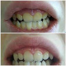 This Is My Sister Hillary After Mixing And Applying Baking Soda And Lemon Juice With A Cotton Ball To Your Tee Baking Soda And Lemon Baking Soda Brushing Teeth