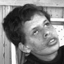 PDF) Schmid-Fraccaro Syndrome: Severe Neurologic Features