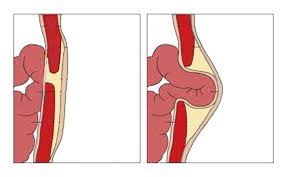 Pressure in lower left abdomen when sitting not rated yet hello. Hernia Or Pulled Abdominal Muscle Know The Difference Prime Surgicare
