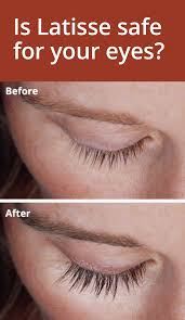 Remove any make up and contacts before any it is still possible to get latisse over the counter which may seem easier, but going to the doctor for a prescription is a good way to make sure that. How To Apply Latisse Video Arxiusarquitectura
