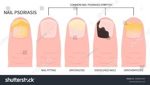 Image result for Pitting nails feet