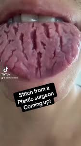 Image result for Fissured tongue