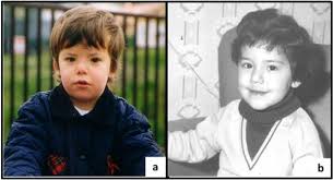 Jun 22, 2016 · the photograph of a patient demonstrated flat nasal bridge and nose, with pointed chin. Picture Of The Patient At Age 2 A Showing The Typical Narrow Forehead Download Scientific Diagram