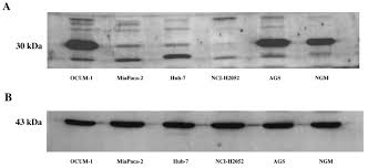 The regional lymph nodes cannot be evaluated. Proteomic Differential Display Analysis Shows Up Regulation Of 14 3 3 Sigma Protein In Human Scirrhous Type Gastric Carcinoma Cells Anticancer Research