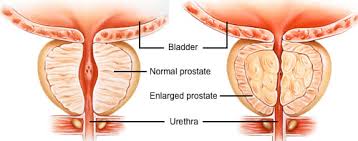 An enlarged prostate usually develops slowly, and your symptoms may never get any worse. Enlarged Prostate Brisbane Urology Clinic