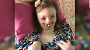 She has been modeling for victoria's secret since 2011 and became a victoria's secret angel in april 2015. Mom Of Girl With Facial Deformity Fights Twitter Troll Who Used Her Daughter S Picture Fox61 Com