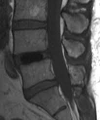 The robotics ensured visualization of the. New Techniques In Lumbar Spinal Instrumentation What The Radiologist Needs To Know Radiology