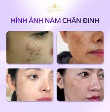 Nám chân đinh: Nguyên nhân, dấu hiệu nhận biết và cách điều trị