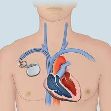 Figure a shows the location and general size of an icd in the upper chest. Implantationen Medizinische Klinik I Krankenhaus Martha Maria Nurnberg Krankenhaus Nurnberg