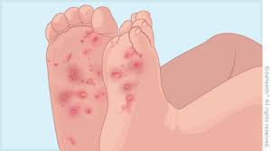Image result for scabies human children