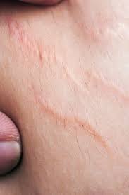 What causes tiger stripes on skin. Stretch Marks On Thighs Appearance Causes And Treatments