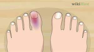 Check spelling or type a new query. How To Know If Your Toe Is Broken Advice From A Foot Surgeon