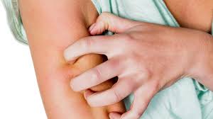 Fieber, geschwollene lymphknoten, gelbsucht, gewichtsverlust und andere symptome einer den gesamten körper betreffenden (systemischen) erkrankung. Nesselsucht Symptome Erkennen Und Lindern Zdfmediathek