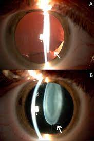Marfan Syndrome Ocular Findings And Novel Mutations In Pursuit Of Genotype Phenotype Associations Canadian Journal Of Ophthalmology