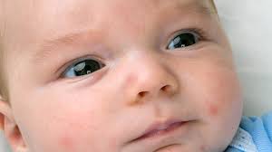 Image result for sweat rash on back baby