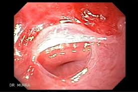 The gastric cardia seen from an retrogade endoscopy from the hole of surgical gastrostomy performed 16 years previous, the. Plummer Vinson Syndrome The Gastrointestinalatlas Gastrointestinalatlas Com
