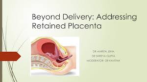 Image result for Retained Placenta