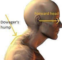 As the elderly woman's posture deteriorated, a hump would develop on the back of their upper thoracic spine and became known as a dowager's hump. Follow These Simple Exercises To Fix Your Dowager S Hump Right Now Get Rid Of The Bump At The Base Of Your Neck Once And Exercise Easy Workouts Back Exercises