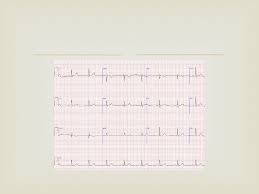 Elektro, karena berkaitan dengan elektronika, kardio, kata yunani untuk jantung, gram. Soal Latihan Interpretasi Ekg