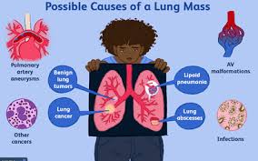 Most of these cancers start in your bone marrow where blood is produced. Lung Cancer Causes And Risk Factors