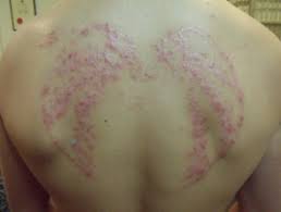 Black henna tattoos can be nightmare star tribune. Black Henna Tattoo Reaction Dermnet Nz