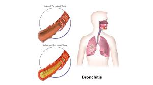 Image result for Acute Bronchitis