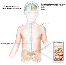 A bone marrow transplant is a medical treatment that replaces your bone marrow with healthy cells. Non Hodgkin Lymphoma University Hospitals