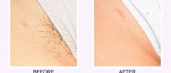 Things can get a little hairy with this process sometimes. I Want My Excess Hair Reduced I Want Laser Hair Removal