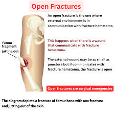 Image result for Open Fracture