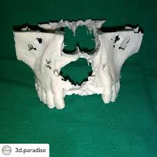 Posted Withrepost 3d Paradise Conversion Of Dicom Images To Stl And Then 3d Printed For Surgery Planning Determining And Practicing 3dprintingindia 3dpri