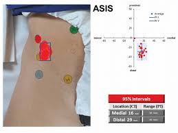 The latissimus dorsi, click and the latissimus dorsi, quadratus lumborum, erector spine, iliacus, tensor fasciae latae, and abdominal muscles attach along the surface of this ridge. Sample Of All Examiner Overlay Image For Anterior Superior Iliac Spine Download Scientific Diagram