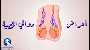 اعراض دوالي الخصية youtube