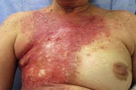 Image result for Radiation Dermatitis