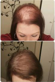 Try these hair loss remedies! Hairloss This Is Before After Pics In Just 5 Weeks With Monat 864 366 0609 Monat Hair Grow Long Hair Hair Solutions