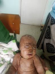 Image result for Ichthyosis