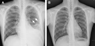 Image result for Pleural Tuberculosis